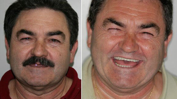 Planificación y colocación de implantes con CAD/CAM