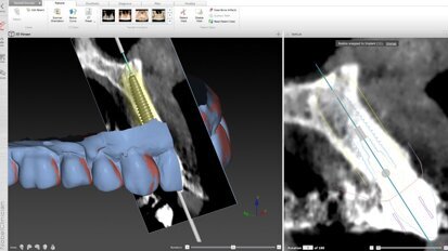 Η Ψηφιακή εποχή στην εμφυτευματολογία.