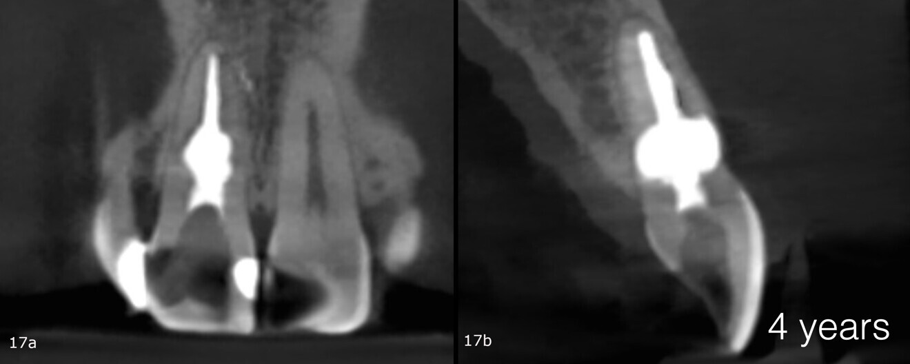Figs. 17a & b: CBCT scan taken four years after the treatment.
