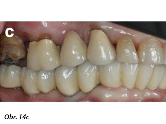 Zdravý stav periimplantátové sliznice a finální CAD/CAM náhrada bezprostředně po nasazení pacientce.