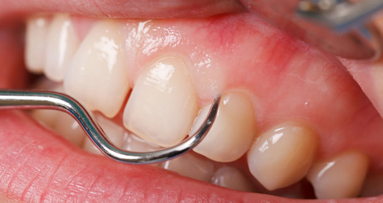 Les cellules souches gingivales pourraient être utilisées dans la régénération tissulaire