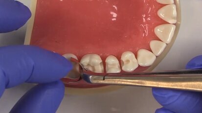 Improve Your Matrix Band Placement with This Quick Tip