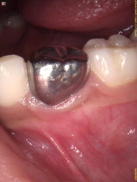 Fig. 13 : Aspect clinique lors de l’évaluation finale montrant un tissu gingival sain.