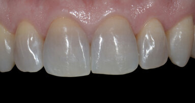 Aesthetic restoration of discoloured anterior teeth using feldspathic porcelain veneers