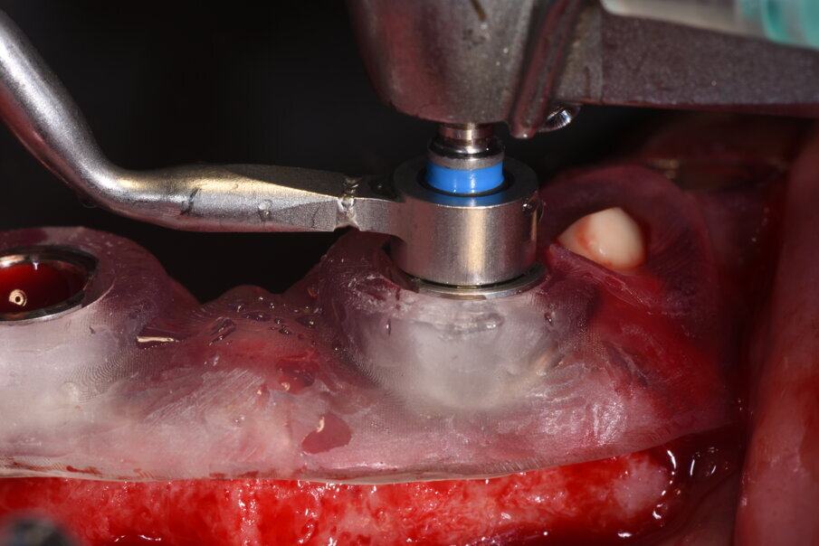 Fig. 19_La dima chirurgica per essere stabile deve avere il maggior appoggio disponibile evitando l’interferenza con i lembi e lasciando degli opercoli che possano consentire la visione dell’avventata calzata corretta. Visione della prima fresa pilota da 2.2 mm con il posizionatore correlato. Se non fosse raggiunto una adeguata stabilità è possibile dopo questo primo passaggio poter posizionare uno stop che si inserisce nel foro praticato nella porzione ossea.