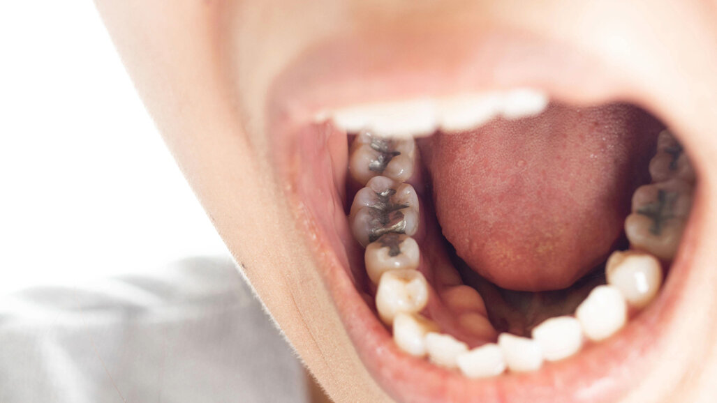 Amalgam versus composite: UK study warns of care crisis over 2034 phase-out