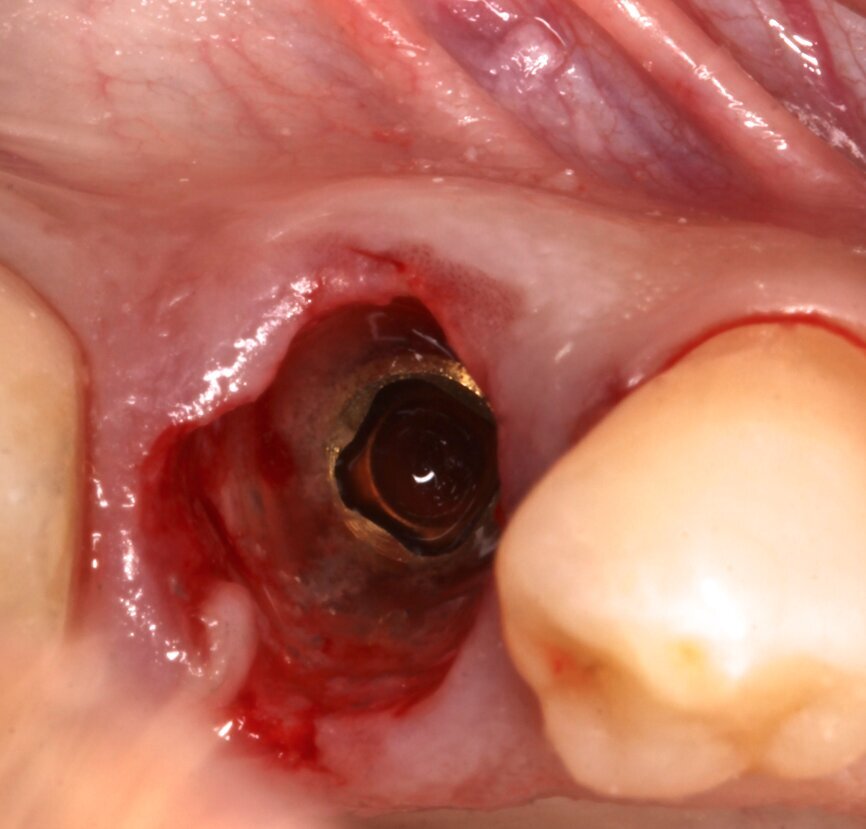 Fig. 3: Implant without intermediate abutment.