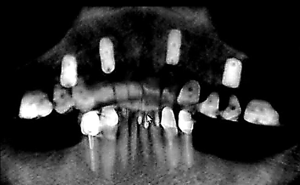Fig. 17: Panoramic radiograph taken after implant placement.