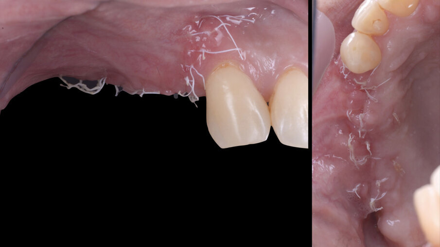 Fig. 7 - Guarigione a 14 giorni.