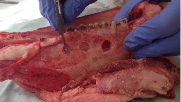 Podśluzówkowa i śródkostna lokalizacja metalowych ciał obcych metodą rezonansu