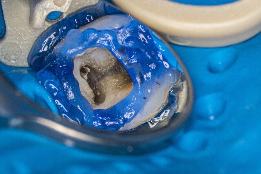Fig. 17: Tooth after removal of the caries and sealing of the chamber with flowable composite and dental dam.