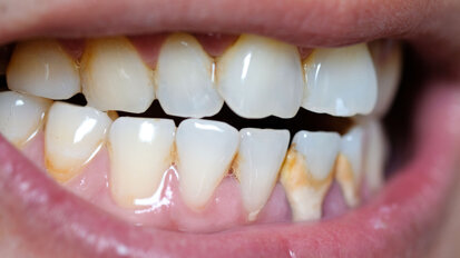 Tandarts Charlotte Jorna: “Tandsteen is zoals een kalkkring in de wasbak”