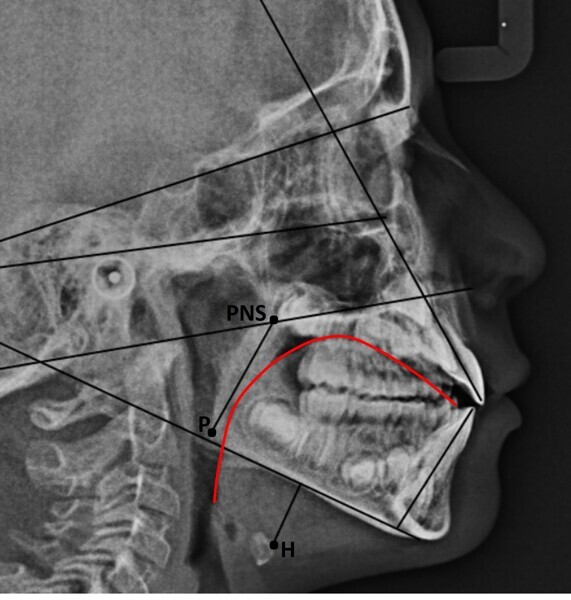 Fig. 16a: Comparison of the cephalometric radiograph, functional tracing and lingual position at the (a) start (red line) and (b) end of treatment (green line). PNS = posterior nasal spine; H = hyoid bone; P = tip of the soft palate.