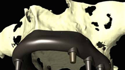 La revolucion de las barreras oclusivas