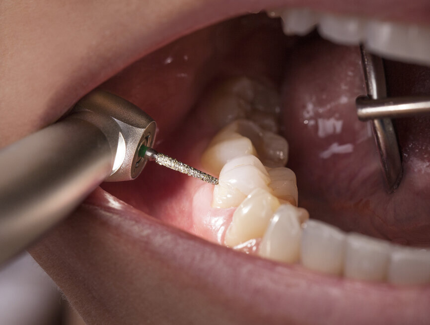 The position of the LED light on the turbine head guarantees the best visibility and illumination at the treatment site. (Photograph: W&H)