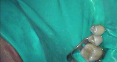 Le champ opératoire en endodontie (et ailleurs) : L’élément primordial du succès