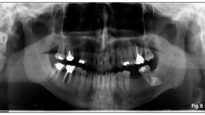 Cutaneous sinus tracts: An endodontic approach