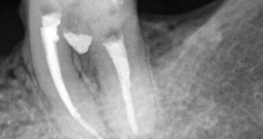 Drilling treatment  using the new MTA Repair HP. Clinical Case Report