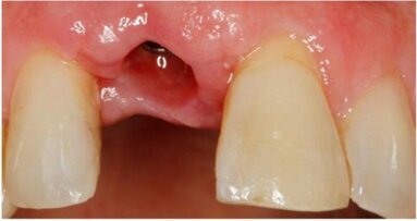 Wykorzystanie technologii cyfrowych podczas uzupełniania braku siekacza przyśrodkowego szczęki