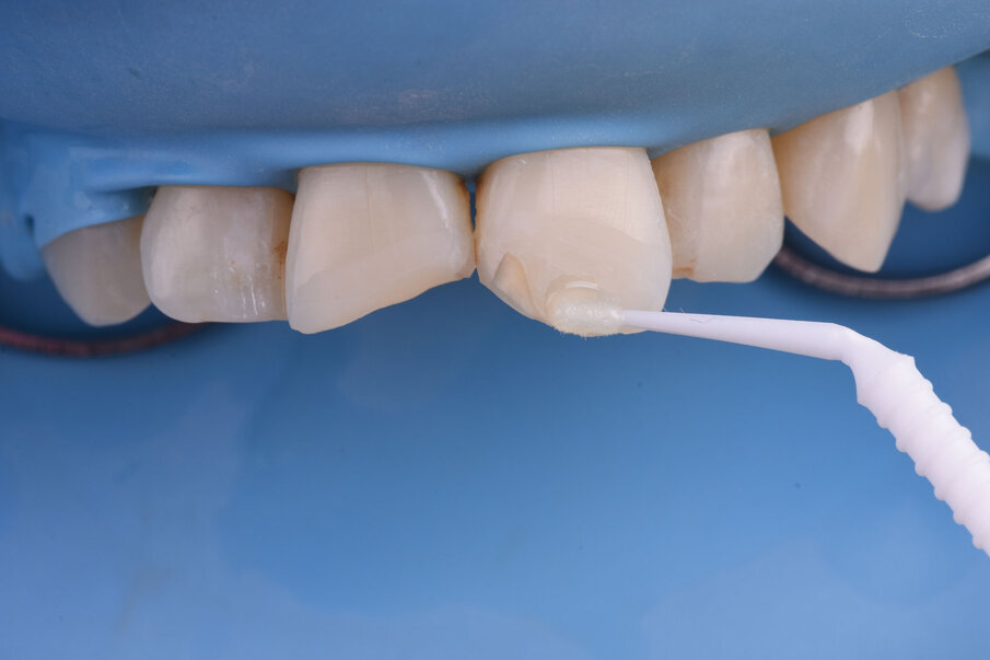 Sl. 7b: Nagrizanje ortofosfornom kiselinom, ispiranje  i aplikacija adheziva (7b). 