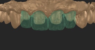 A smooth path towards beautiful smiles: Micro-layering with CERABIEN MiLai