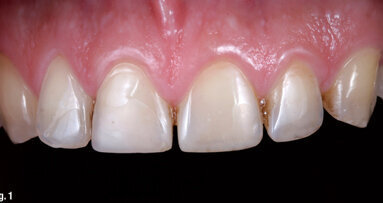 A smile says more than a thousand words: Reconstruction & modification of anterior teeth