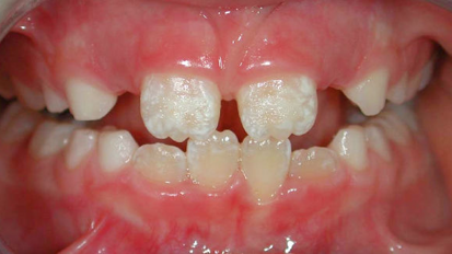 Липсата на естествено хранене може да предразположи децата към емайлови дисплазии