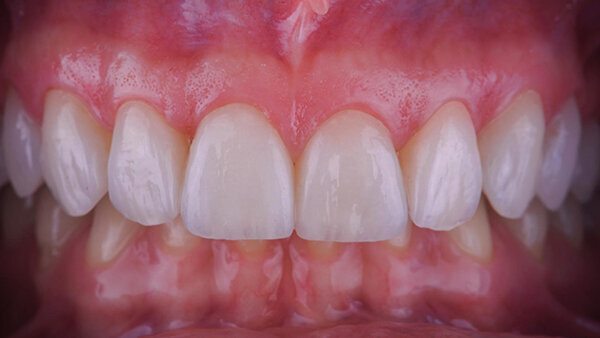 Fig. 17b. Resultado final una semana después, vista frontal.