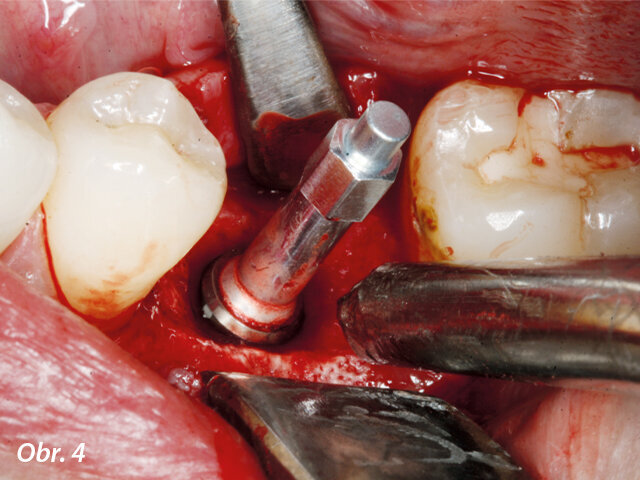 Našroubovaný měřicí pin SmartPeg použitý ke změření kvocientů stability implantátu pomocí integrovaného modulu W&H Osstell ISQ.