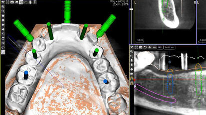 Počítačem asistované, šablonou se řídící okamžité zavedení a zatížení implantátu v dolní čelisti