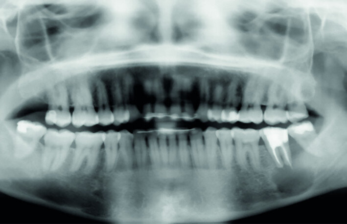 Fig. 15a: Radiograph: Pre-op panoramic.