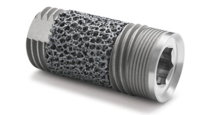 Clinical evidence reveals unique biological response to Trabecular Metal dental implant