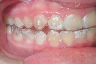 Upper and lower Invisalign aligners with the new precision wings feature engaged, and the mandible advanced to an edge-to-edge position.