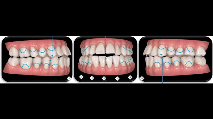 Fig. 4_Programmazione del posizionamento della base ossea in base all’occlusione, mantenendo le linee mediane centrate.