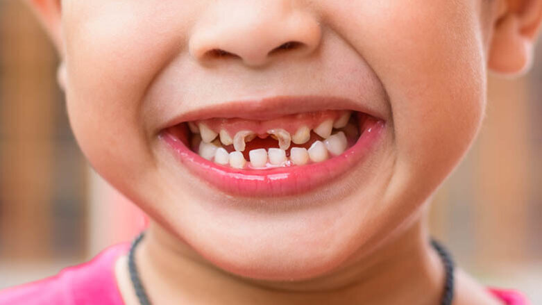 Novo estudo pode ajudar a melhor prevenção da cárie na primeira infância