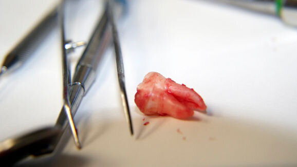 Thousands of teeth may unnecessarily be pulled for profit in UDA system