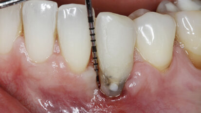 Management kosti a měkkých tkání při komplexní rekonstrukci jednoho zubu implantátem