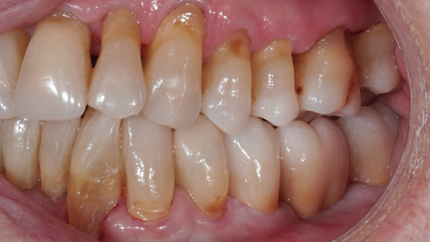 Fig. 11: Clinical situation after restoring the teeth with a lithium disilicate onlay and a zirconia bridge.