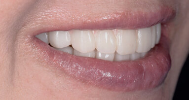 Customised aesthetics for provisional profile prosthesis with ceramage gum