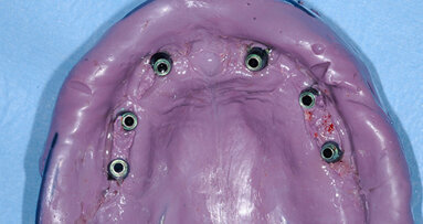 Pianificazione implanto-protesica in un caso clinico complesso