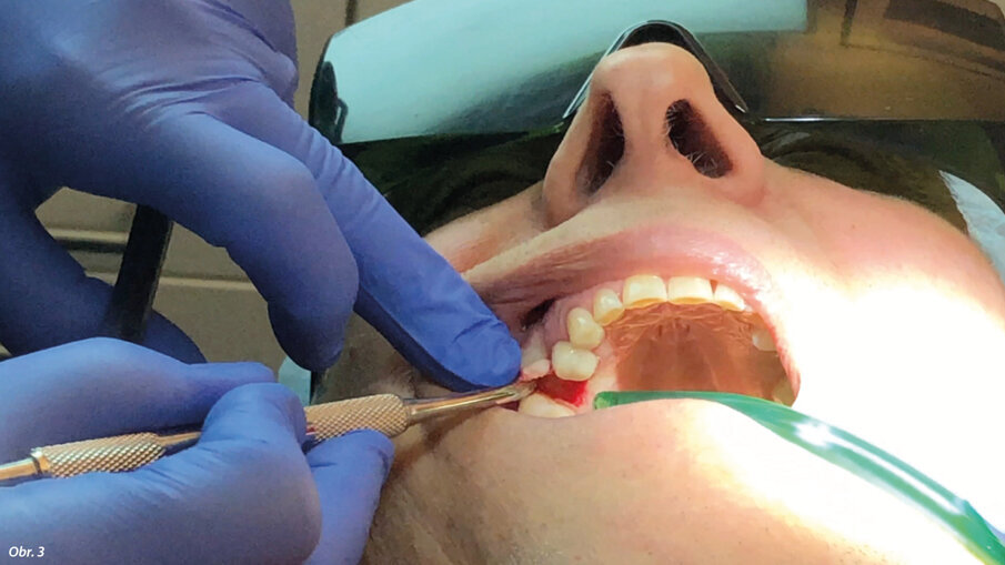 Stabilizovaný laser preparující osteotomii, pracoval při 380 mJ, 20 Hz a 50 mikrosekundách