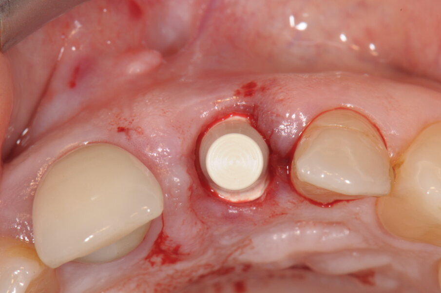 Fig. 9 - Posizionamento di una coppetta in resina come base d’appoggio per la ribasatura del provvisorio.