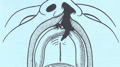 Recenti sviluppi sulla Genetica delle Schisi Orofacciali