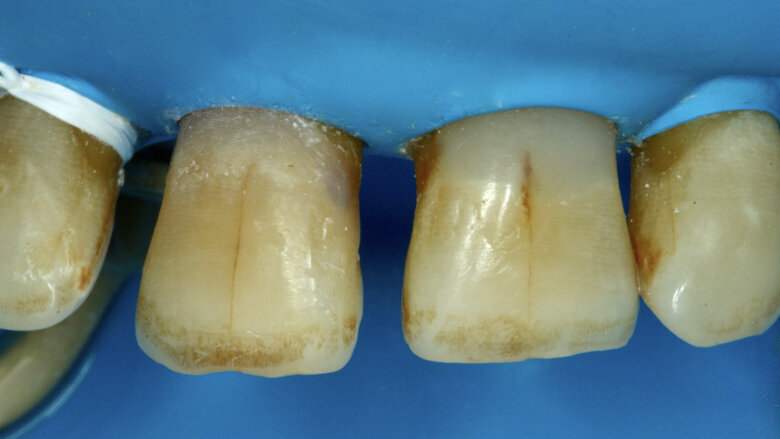 Figura 17. La restauración finalizada.