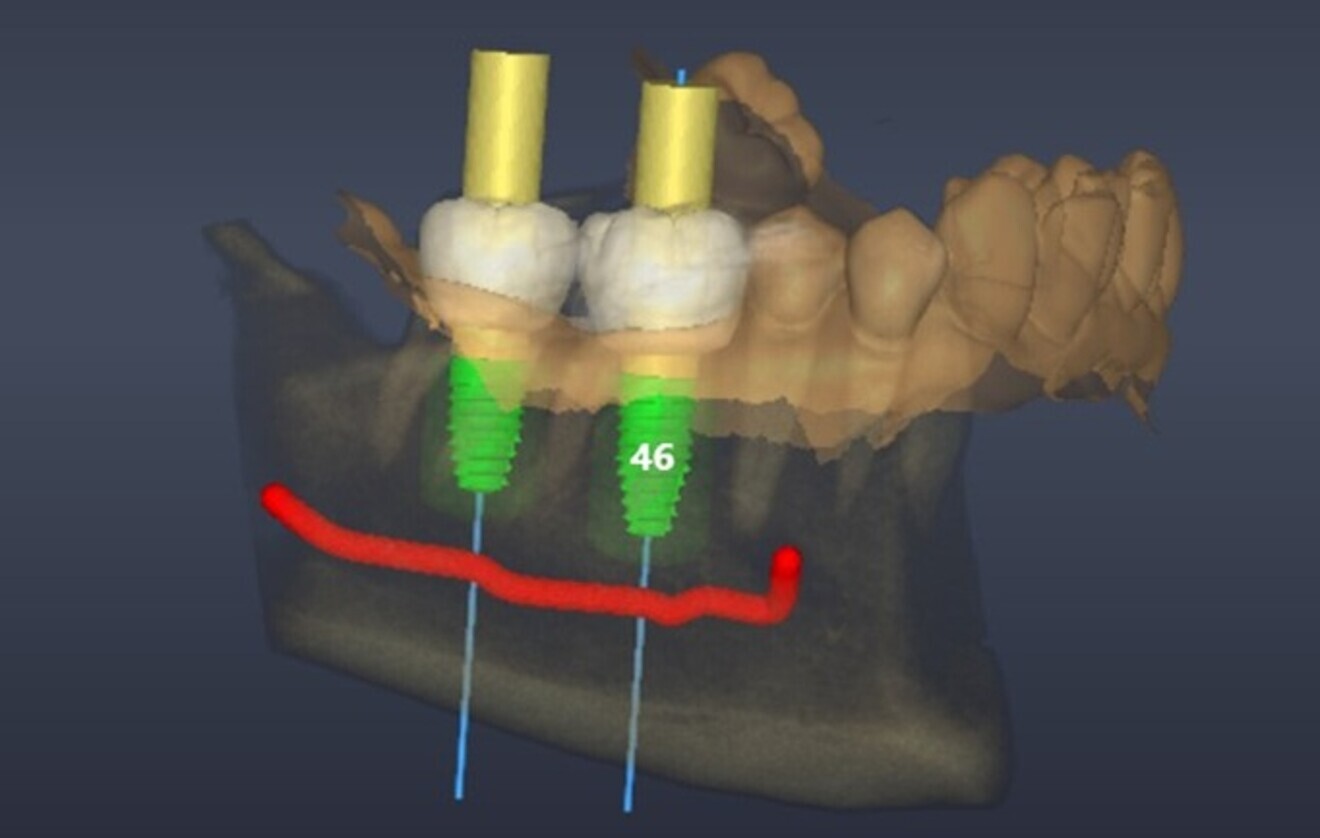 Fig. 5: Digital implant planning, labial view. 