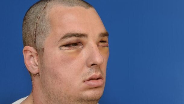 Dental, facial reconstructive surgeons perform most extensive full-face transplant