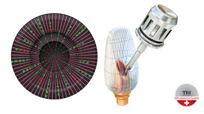 TRI präsentiert das erste digitale Implantat der Welt TRI präsentiert das erste digitale Implantat der Welt