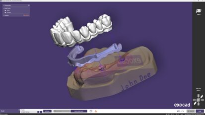 Exocad launches PartialCAD 3.3 Chemnitz with split denture workflow
