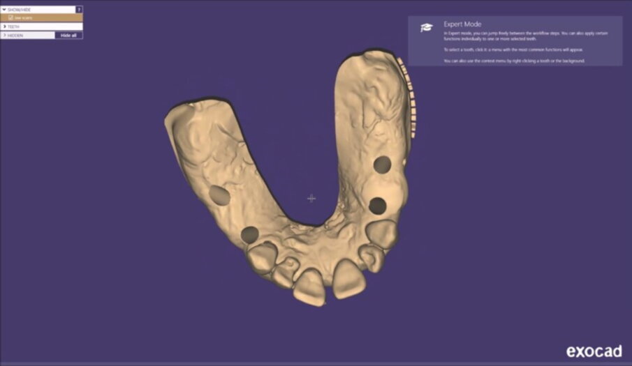 Figg. 21-25_Progettazione Cad con exocad.