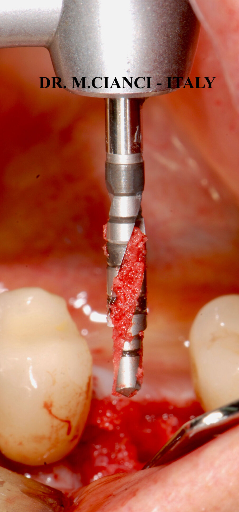 Fig. 4 - Fresa elicoidale per la raccolta di osso autologo.